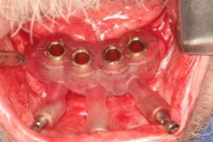 Guided dental implant placement