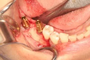 Simultaneous implant placement and graft