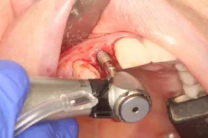 Immediate dental implants